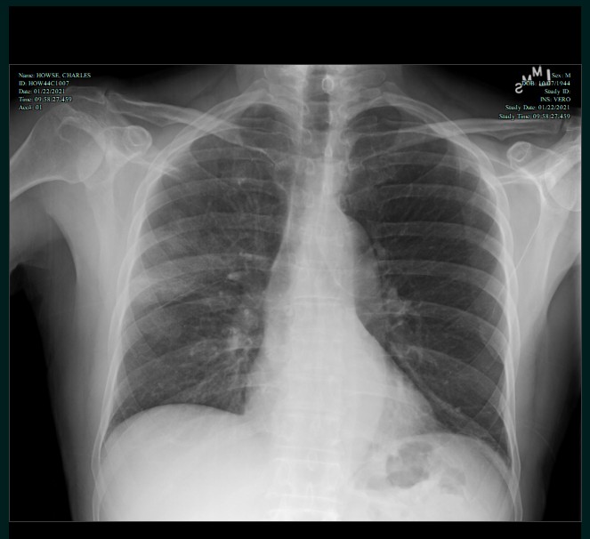 chest xray front.png
