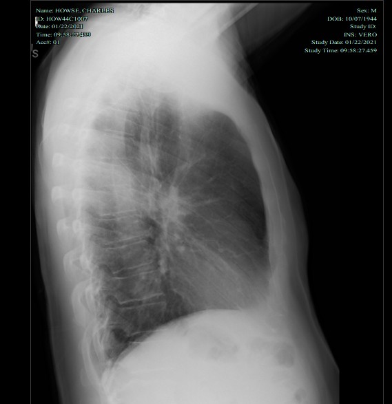 chest xray side.png